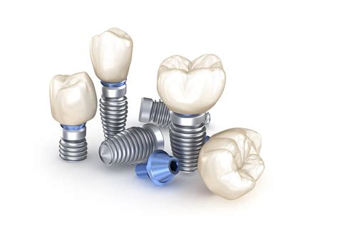 The 5 Best Long-Term Tooth Replacement Options