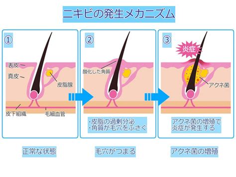 繰り返しできるニキビから解放されたい！原因や予防法とは？ 美容コラム はなふさ皮膚科・美容皮膚科 関東・関西・東海・九州エリアに15院