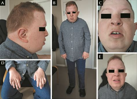 Jle Epileptic Disorders Trisomy 20pmonosomy 18p Associated With Congenital Bilateral