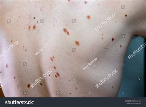 Melanocytic Nevus Known Nevocytic Nevuscell Commonly Stock Photo