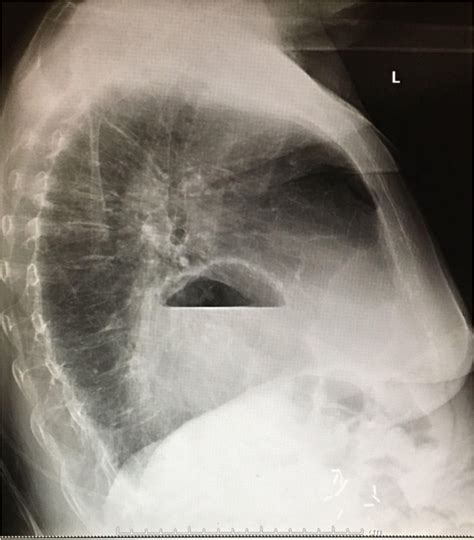 Figure 2 Lateral View Obvious Air Fluid Level Seen In Hiatal Hernia