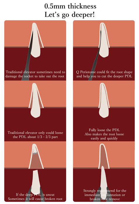 periotome senka dental supply