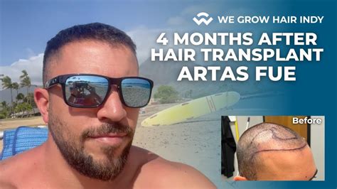 4 Months After ARTAS Robotic FUE Hair Transplant We Grow Hair Indy