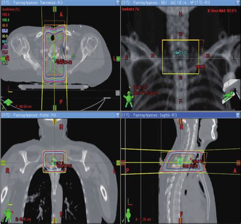 Radiation Treatment Fields T1 Lesion Treated With Anterior Posterior Download Scientific