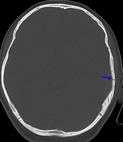 Pearls And Pitfalls Of Pediatric Head Trauma Imaging Applied Radiology