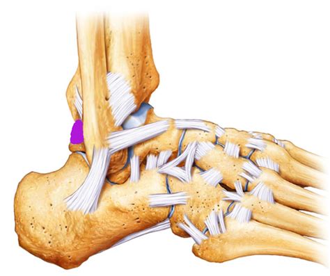 Anterior Talofibular Ligament Leaguewes