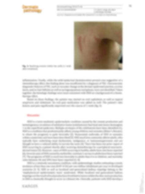 Solution Staphylococcal Scalded Skin Syndrome In An Adult On