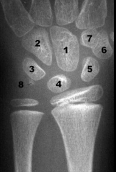 Wrist Trauma Radiographic Evaluation Hand Orthobullets