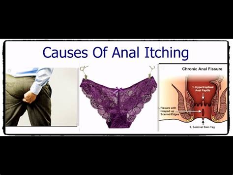 Causes of Anal Itching تعرف على اسباب حدوث هرش فى منطقه الشرج YouTube