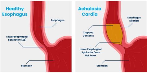 Achalasia Cardia – CIGIS Hospital