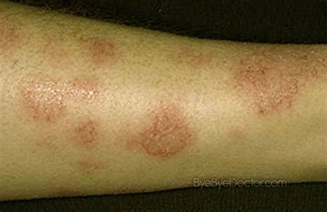 Nummular Dermatitis Pictures Pictures Photos