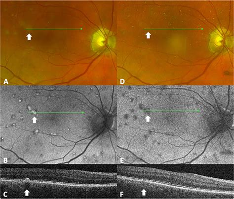 West Nile Virusrelated Retinal Pigment Epithelium Changes On