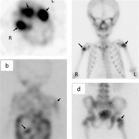 A B Whole Body Iodine 123 Metaiodobenzylguanidine Scan Shows Uptake