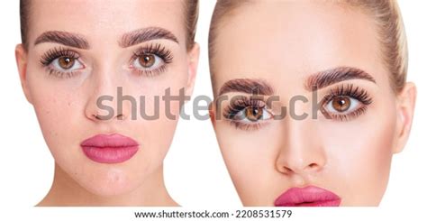 Young Woman Before After Acne Treatment Stock Photo 2208531579 | Shutterstock