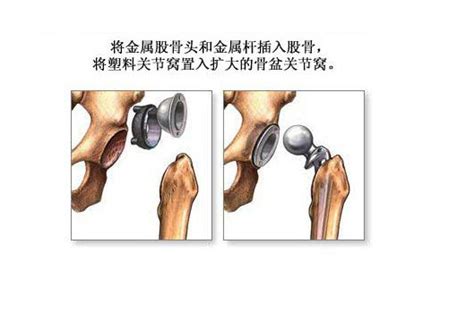 髋关节置换术 手术图解医学图库