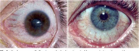 Conjunctival Hyperemia