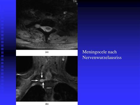 PPT MRT bei Plexus brachialis Läsionen PowerPoint Presentation free