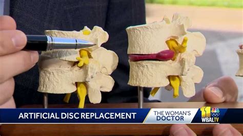 The Womans Doctor Artificial Disc Replacement