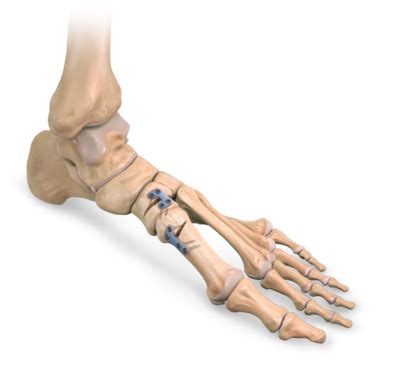 5th Metatarsal Osteotomy