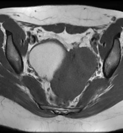 Ovarian Endometrioma Hemorrhagic Cyst Image Radiopaedia Org