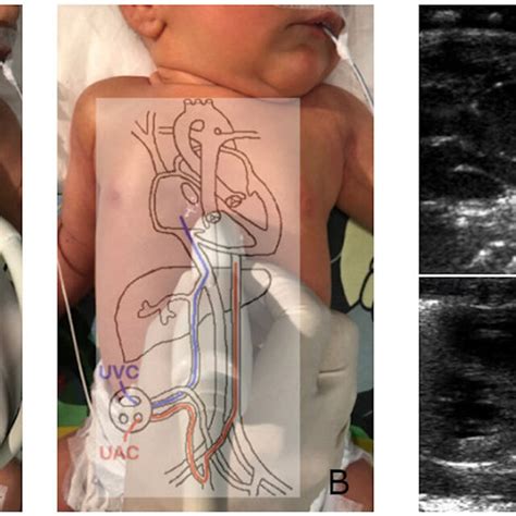 Proper Uvc A And Uac B Imaging And Positioning The Uvc Leaving