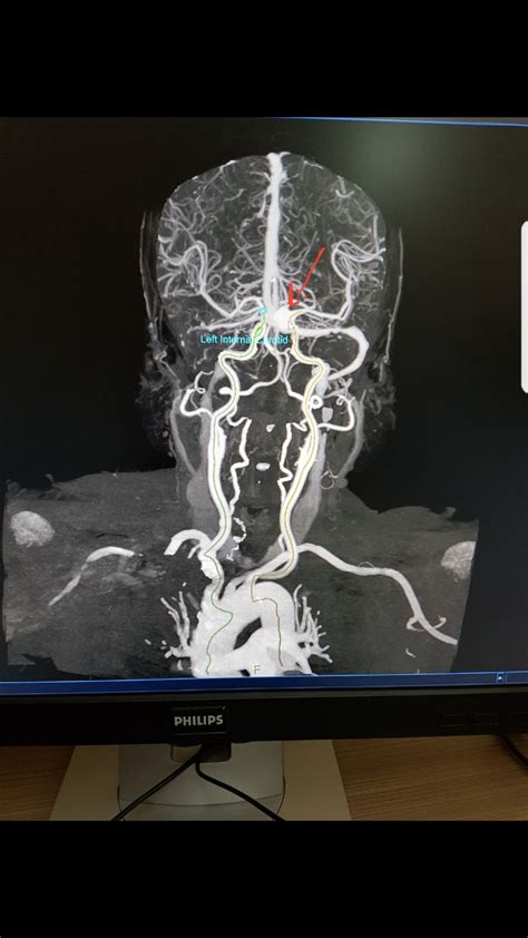 Contoh Hasil Ct Scan Kepala Perawat Perlu Tahu Cara Penanganan Pasien