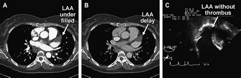 Multidetector Computed Tomography With Delay Imaging For Detection Of