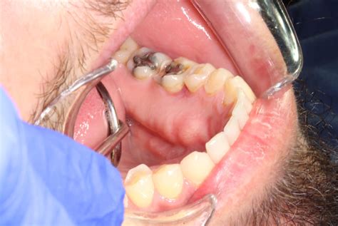 Granuloma Pi Geno Gingival Recidivante Caso Cl Nico Gaceta Dental