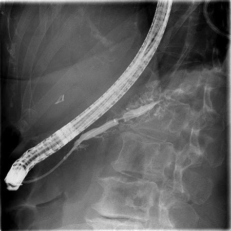 Pancreatoscopy Guided Laser Dissection And Ablation For Treatment Of Benign And Neoplastic