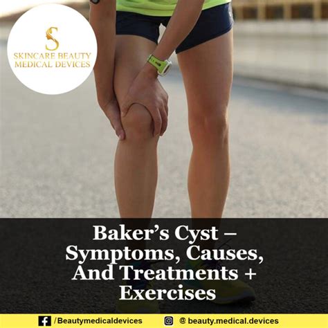 Baker’s Cyst – Symptoms, Causes, And Treatments + Exercises