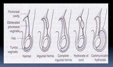 Luahan Hati Olalajuon Penyakit Angin Pasang Inguinal Hernia