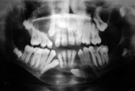 Orthopantomograph Showing Multiple Cysts In Maxilla And Mandible