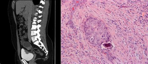 Schistosomiasis Induced Squamous Cell Bladder Carcinoma In An Hiv Infected Patient