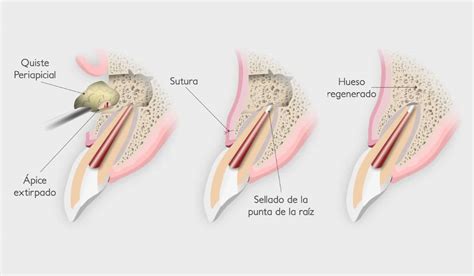 Apicectomía Qué es y cuándo debe realizarse Julián Saiz
