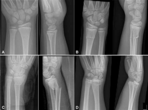 Greenstick Fracture Definition And Treatment Lecturio Medical