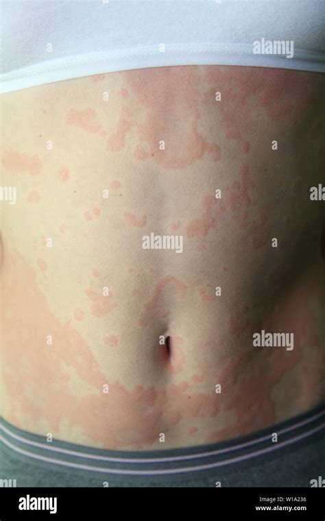 Dermatitis Alérgica La Piel De La Chica Es Sorprendido Por Dermatitis