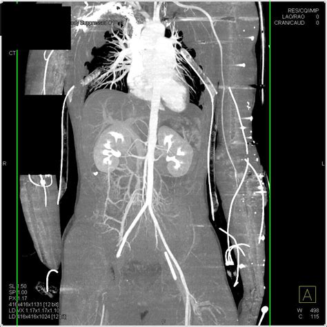 Ct Pan Scan