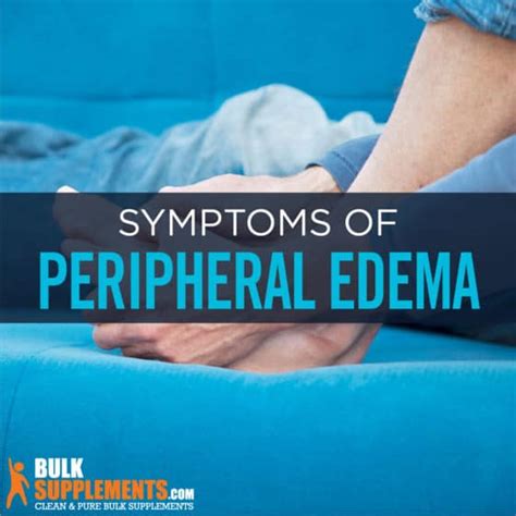 Peripheral Edema: Symptoms, Causes & Treatment