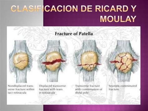 Fractura De Rotula Ppt