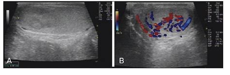 Figure 1 From Benign Testicular Cavernous Hemangioma Presenting With