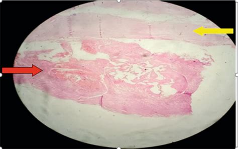 Low Power Photomicrograph Revealing Fibrotic Cyst Wall Yellow Arrow