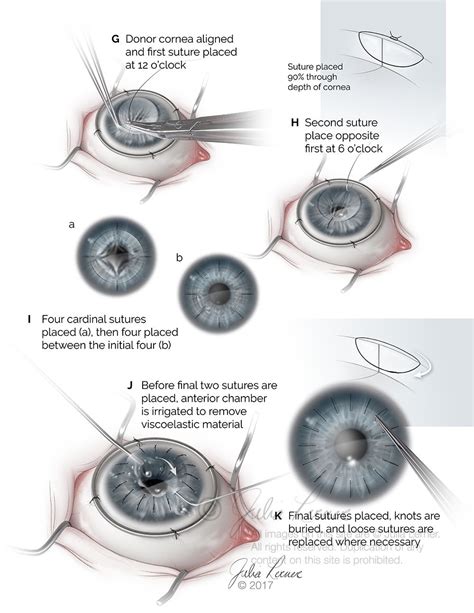 Penetrating Keratoplasty Pk Julia Lerner Illustration Eye