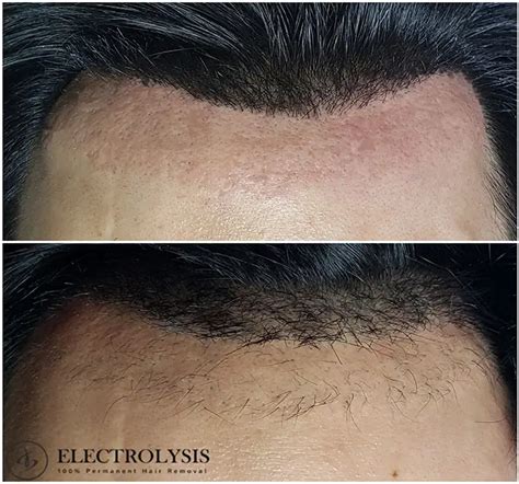 Electrolysis Before And After 100 Permanent Hair Removal