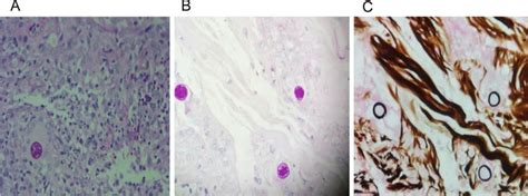 Biopsy Of Back Rash Subcutaneous Tissue A He Stain And B Psa Stain