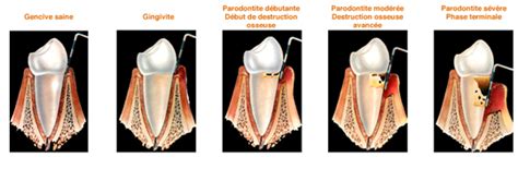 La Maladie Parodontale Dr Nathalie Gros Dentiste à Cergy