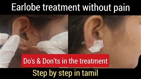 Earlobe Surgery Without Pain 👂 Earlobe Surgeryearlobe Treatment In