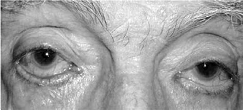 A An 88 Year Old Male With Bilateral Involutional Lower Lid Ectropion