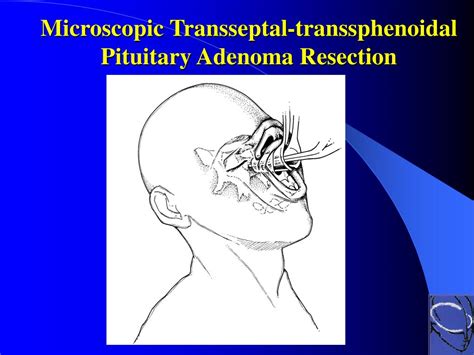 Ppt From An Open Transcranial To A Minimally Invasive Endoscopic