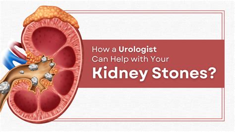 Kidney Stone Surgery: Recovery, Complications, and Types