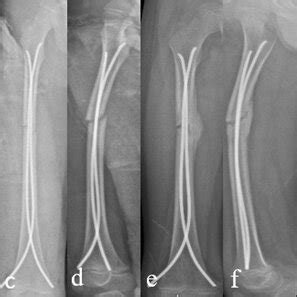 Figures A And B Show Pre Op X Ray Figures C And D Show Immediate